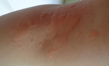 荨麻疹怎么治疗最快好:荨麻疹怎么治疗最快好?这4个方法帮你快速缓解症状