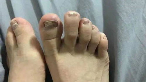 有灰指甲怎么办才能根除:有灰指甲怎么办才能根除?这些方法值得一试!