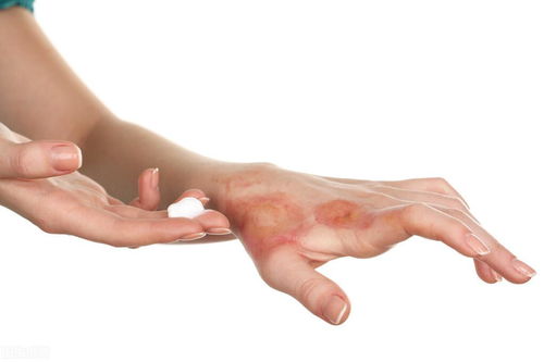 烫伤后的红色疤痕怎么去除:烫伤后红色疤痕的消除方法