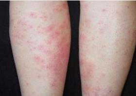 怎样确认自己得了红斑狼疮:红斑狼疮的确认,从症状到诊断 怎样确认自己得了红斑狼疮:红斑狼疮的确认,从症状到诊断