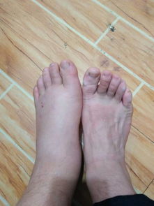 脚扭伤后千万不要一直躺着:脚扭伤后千万不要一直躺着,这4个黄金原则请收好! 脚扭伤后千万不要一直躺着:脚扭伤后千万不要一直躺着,这4个黄金原则请收好!