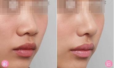 膨体隆鼻手术价格:膨体隆鼻手术价格参考,全面解析与选择指南 膨体隆鼻手术价格:膨体隆鼻手术价格参考,全面解析与选择指南