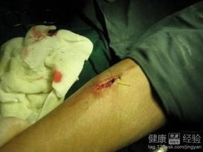 脂肪瘤会自己消失吗:脂肪瘤会自己消失吗?答案在这里! 脂肪瘤会自己消失吗:脂肪瘤会自己消失吗?答案在这里!