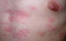 荨麻疹症状及治疗方法:认识荨麻疹,症状与治疗方法,助您轻松应对 荨麻疹症状及治疗方法:认识荨麻疹,症状与治疗方法,助您轻松应对