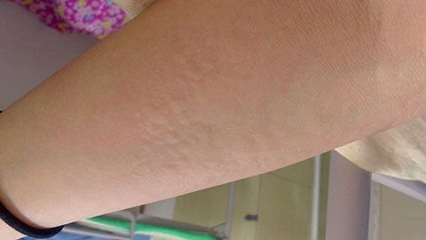 荨麻疹症状及治疗方法:认识荨麻疹,症状与治疗方法,助您轻松应对 荨麻疹症状及治疗方法:认识荨麻疹,症状与治疗方法,助您轻松应对