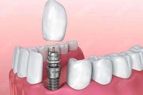 南京种牙多少钱一颗啊:南京种牙价格大揭秘,从几百到几千,你需要知道的都在这!