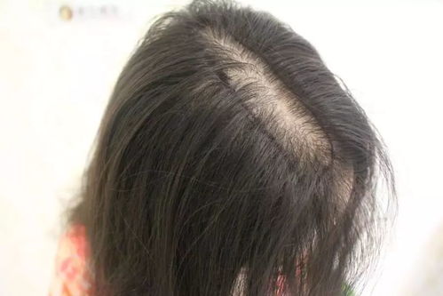 头发掉发严重怎么调理:头发掉发严重怎么调理?全面指南,重拾浓密秀发!