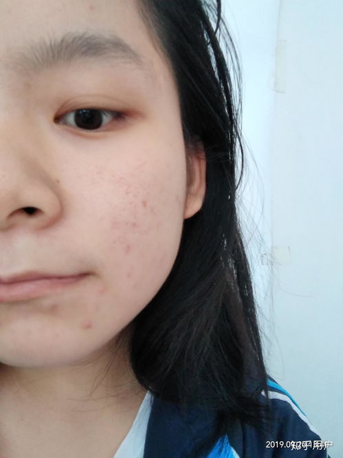 二十多岁女孩脸上长痘痘是怎么回事:二十多岁女孩脸上长痘痘是怎么回事?这些原因和解决方法你一定要知道!