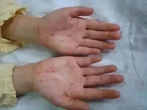 轻微紫癜初期症状图片:轻松识别!轻微紫癜初期症状与图片解析,早发现早应对 轻微紫癜初期症状图片:轻松识别!轻微紫癜初期症状与图片解析,早发现早应对