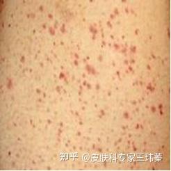 轻微紫癜初期症状图片:轻松识别!轻微紫癜初期症状与图片解析,早发现早应对 轻微紫癜初期症状图片:轻松识别!轻微紫癜初期症状与图片解析,早发现早应对