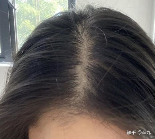 女生脱发严重怎么解决:女生脱发严重怎么办?科学解决方法大揭秘! 女生脱发严重怎么解决:女生脱发严重怎么办?科学解决方法大揭秘!