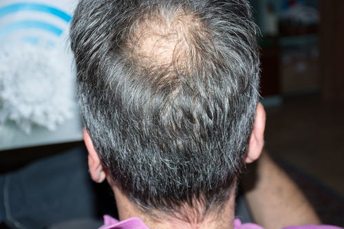 女生脱发严重怎么解决:女生脱发严重怎么办?科学解决方法大揭秘! 女生脱发严重怎么解决:女生脱发严重怎么办?科学解决方法大揭秘!