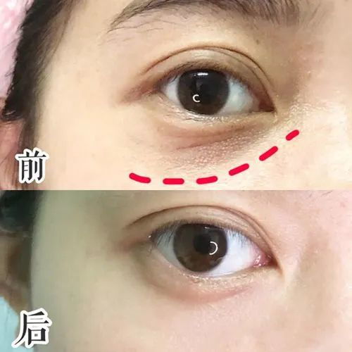 眼部长了脂肪粒怎么去除:告别眼周脂肪粒,轻松拥有清澈双眸! 眼部长了脂肪粒怎么去除:告别眼周脂肪粒,轻松拥有清澈双眸!