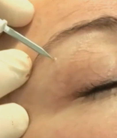 眼部长了脂肪粒怎么去除:告别眼周脂肪粒,轻松拥有清澈双眸! 眼部长了脂肪粒怎么去除:告别眼周脂肪粒,轻松拥有清澈双眸!