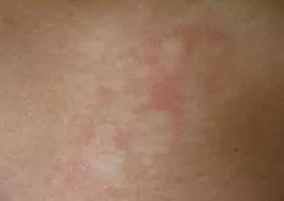 得白点癫风的前兆:白癜风早期症状,认识那些不容忽视的白点 得白点癫风的前兆:白癜风早期症状,认识那些不容忽视的白点