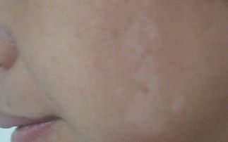 得白点癫风的前兆:白癜风早期症状,认识那些不容忽视的白点