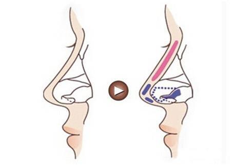 割下颌角多少钱:割下颌角到底要花多少钱?全面解析价格与影响因素 割下颌角多少钱:割下颌角到底要花多少钱?全面解析价格与影响因素