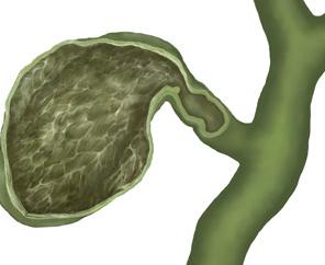 胆囊炎怎么治疗最好的方法:胆囊炎怎么治疗最好的方法 胆囊炎怎么治疗最好的方法:胆囊炎怎么治疗最好的方法
