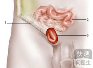 疝气是什么病:认识疝气,了解这种常见疾病的成因、症状与治疗 疝气是什么病:认识疝气,了解这种常见疾病的成因、症状与治疗