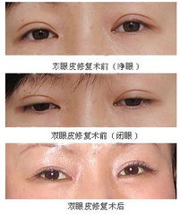 双眼皮失败修复费用由谁承担:双眼皮失败修复费用承担主体解析,法律与责任边界探讨 双眼皮失败修复费用由谁承担:双眼皮失败修复费用承担主体解析,法律与责任边界探讨