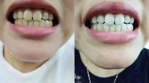 门牙掉了最快的遮丑办法:门牙掉了最快的遮丑办法,这些方法你一定要知道! 门牙掉了最快的遮丑办法:门牙掉了最快的遮丑办法,这些方法你一定要知道!