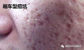 治疗痘印痘坑最有效的方法:告别痘印痘坑烦恼!探寻治疗痘印痘坑最有效的医学美容方法 治疗痘印痘坑最有效的方法:告别痘印痘坑烦恼!探寻治疗痘印痘坑最有效的医学美容方法