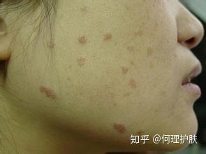 疣的去除方法:科学应对民间偏方与医学手段,疣的多种去除方法解析 疣的去除方法:科学应对民间偏方与医学手段,疣的多种去除方法解析