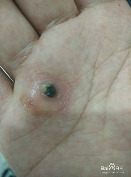 疣的去除方法:科学应对民间偏方与医学手段,疣的多种去除方法解析 疣的去除方法:科学应对民间偏方与医学手段,疣的多种去除方法解析