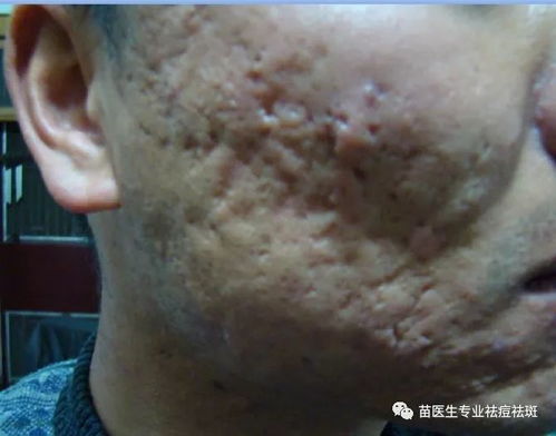 痘坑痘印怎么解决:告别痘坑痘印烦恼,这些方法真的有用! 痘坑痘印怎么解决:告别痘坑痘印烦恼,这些方法真的有用!