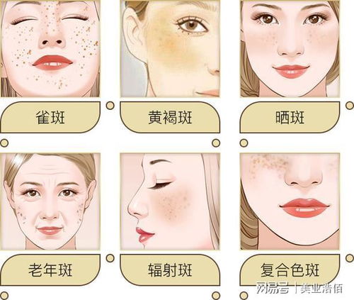 激光祛斑的优缺点:激光祛斑,美丽与风险的双重奏—全面解析其优缺点 激光祛斑的优缺点:激光祛斑,美丽与风险的双重奏—全面解析其优缺点