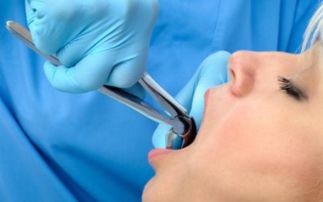 智齿一般疼几天会自愈:智齿疼几天能缓解?这些情况无需拔牙也能自愈