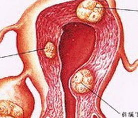 卵巢囊肿是什么原因造成的:卵巢囊肿是什么原因造成的?揭秘女性健康隐患