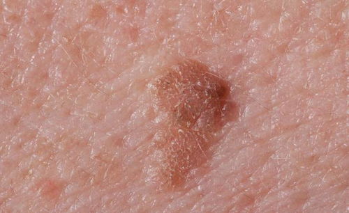 腋下长疣是感染hpv了吗:腋下长疣,是感染HPV了吗?警惕这种小疙瘩背后的健康风险!