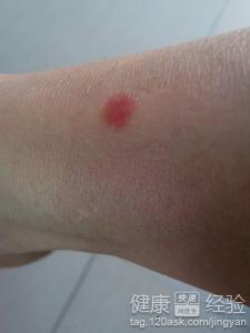 hiv初期淋巴肿大位置图:HIV初期可能症状,认识淋巴结肿大及其常见位置