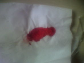 拉屎出血了鲜红色严重吗:拉屎出血了鲜红色,严重吗?这些情况需要警惕!