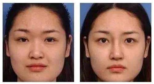 鼻子微整什么方式最好:鼻子微整什么方式最好?全面解析适合你的鼻部整形方案