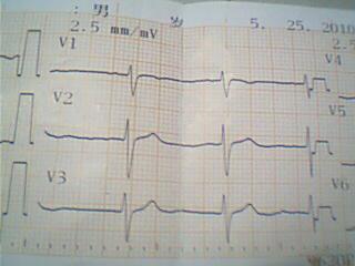 心率在100到120吃什么药:心率在100到120次/分钟,该不该吃药?