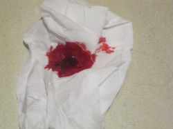 女性大便出血鲜红不痛:女性大便出血鲜红不痛,这些原因需警惕! 女性大便出血鲜红不痛:女性大便出血鲜红不痛,这些原因需警惕!