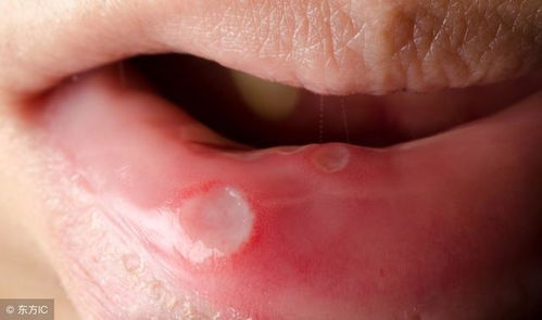 口腔溃疡怎么办最快愈合:口腔溃疡怎么办最快愈合,快速修复指南 口腔溃疡怎么办最快愈合:口腔溃疡怎么办最快愈合,快速修复指南