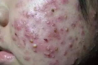 痤疮不治疗自己会好吗:痤疮不治疗会自愈吗?这些情况要注意!