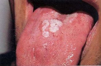 豆腐渣分泌物是hpv感染:豆腐渣分泌物是HPV感染?这些真相你必须知道! 豆腐渣分泌物是hpv感染:豆腐渣分泌物是HPV感染?这些真相你必须知道!