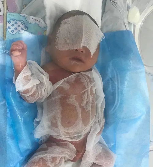 火棉胶婴儿:火棉胶婴儿,历史与现代应用的奇妙连接