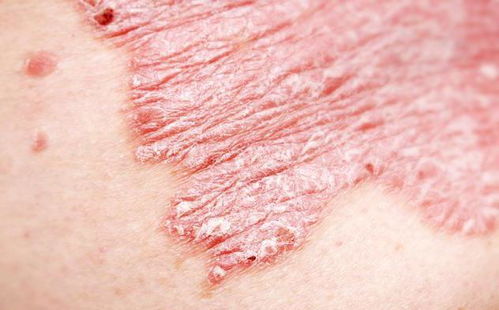 早期银屑癣图片:早期银屑癣图片长什么样?这些症状你需要注意! 早期银屑癣图片:早期银屑癣图片长什么样?这些症状你需要注意!