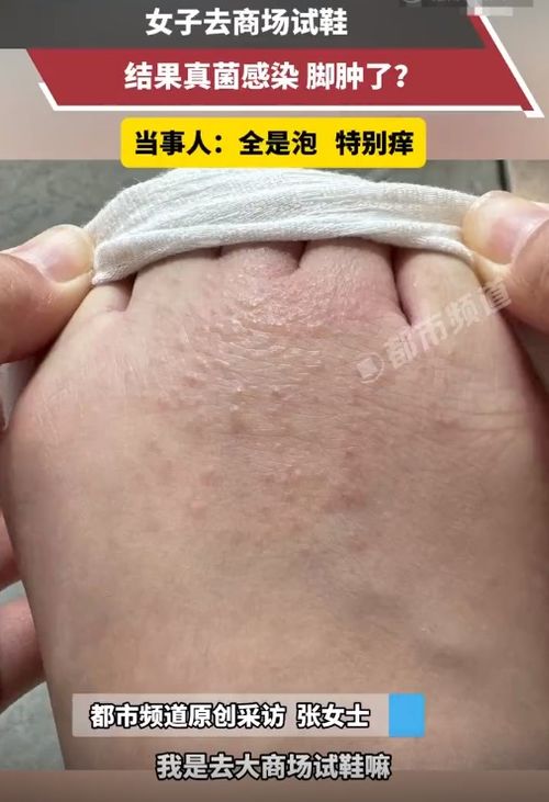 早期银屑癣图片:早期银屑癣图片长什么样?这些症状你需要注意! 早期银屑癣图片:早期银屑癣图片长什么样?这些症状你需要注意!