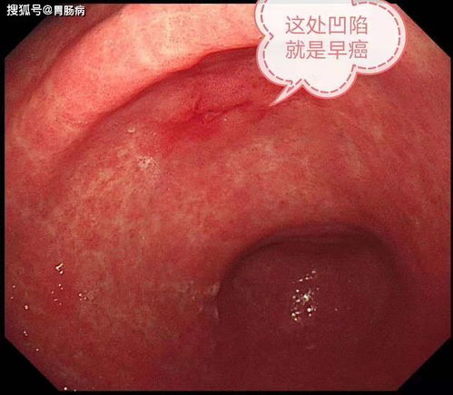 无痛胃镜后悔一辈子:无痛胃镜后悔一辈子,一次舒适的检查,换来终身的后怕 无痛胃镜后悔一辈子:无痛胃镜后悔一辈子,一次舒适的检查,换来终身的后怕