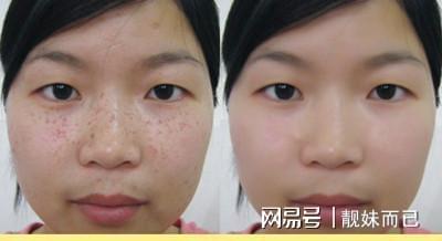 什么祛斑最快最好最简单:一文搞定!什么祛斑最快最好最简单?这些方法你必须知道!