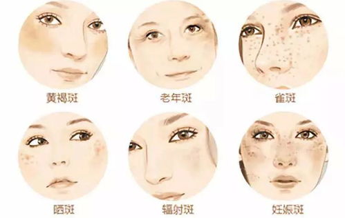 什么祛斑最快最好最简单:一文搞定!什么祛斑最快最好最简单?这些方法你必须知道! 什么祛斑最快最好最简单:一文搞定!什么祛斑最快最好最简单?这些方法你必须知道!