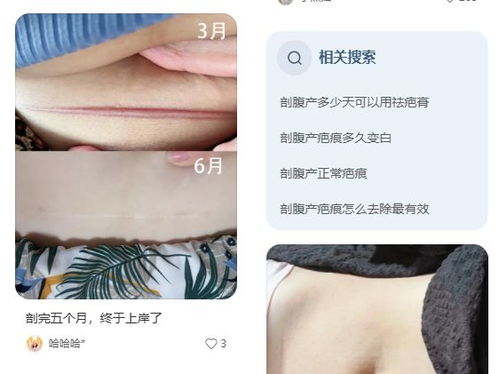 10厘米祛疤手术多少钱:10厘米祛疤手术到底要花多少钱?