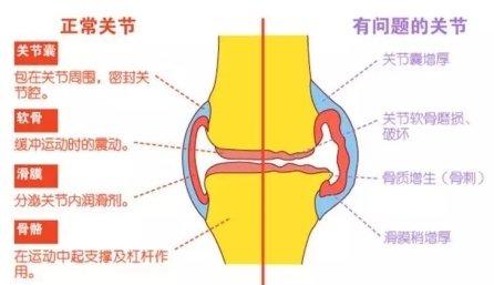 塞来昔布可以消除积液:塞来昔布在消除积液中的应用