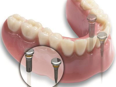 种植牙拔了多久可以种:种牙拔牙后多久可以种?黄金时间了解一下!